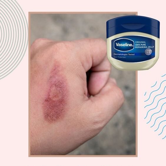 Vaseline woundcare burn