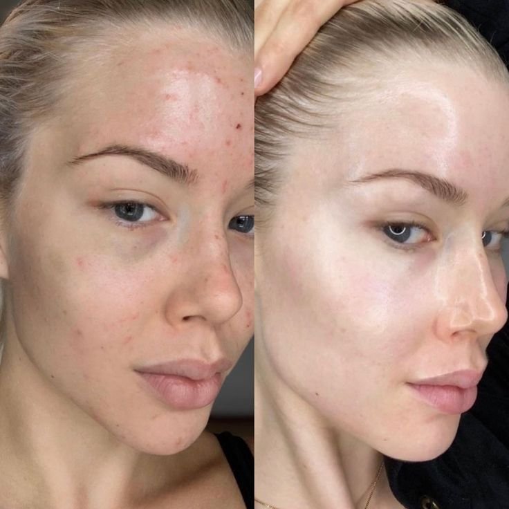 hyperpigmentation before and after